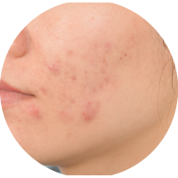 Symptoms of PCOS or PCOD - Acne