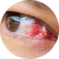 Causes of Lasik Cornea Inflammation due to Eye Diseases Treatment In Chennai