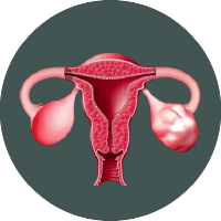 Irregular Periods Due To Uterine Fibroids Treatment In Mumbai      