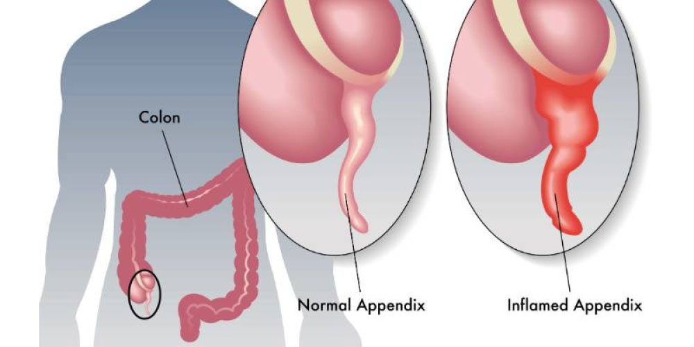 Appendix Pain and Treatment